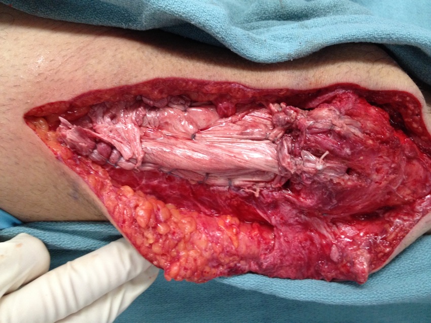 Quads Allograft reconstruction 2